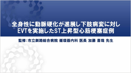 ハイリスク症例を考える 全身性に動脈硬化が進展し下肢病変に対しEVTを実施したST上昇型心筋梗塞症例
