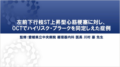 ハイリスク症例を考える 左前下行枝ST上昇型心筋梗塞に対し、OCTでハイリスク・プラークを同定しえた 症例