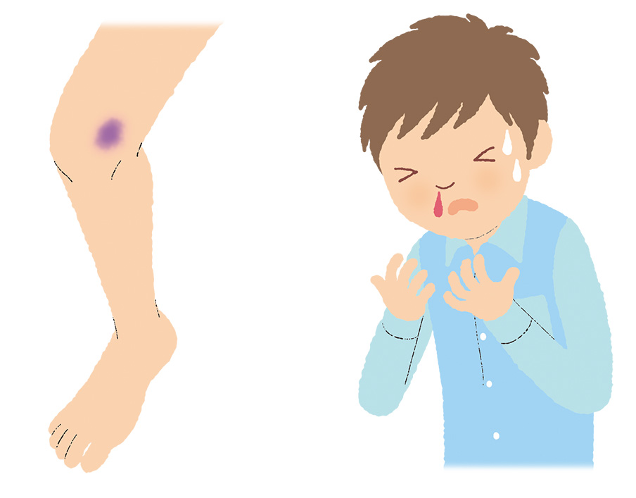 イラスト_播種性血管内凝固症候群（DIC）  