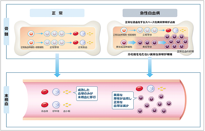 図_ALLの発症機序