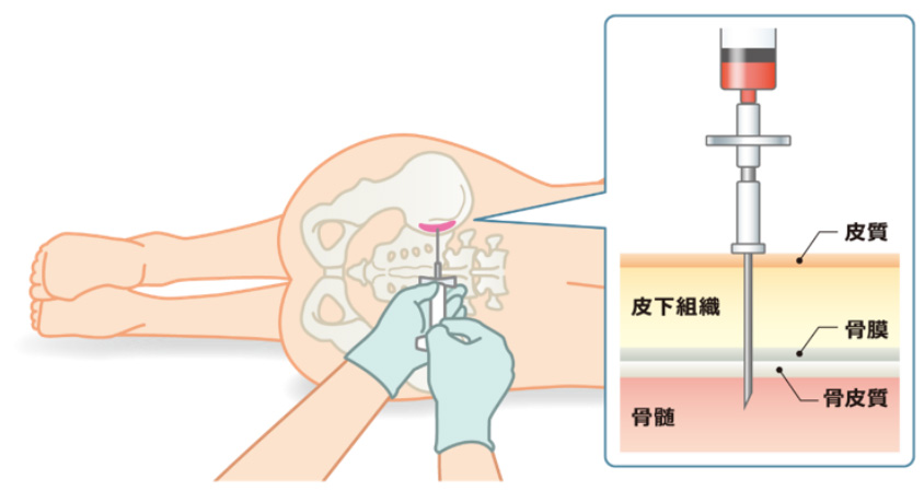 図_骨髄検査の実際