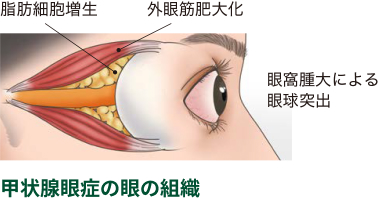 甲状腺眼症の眼の組織