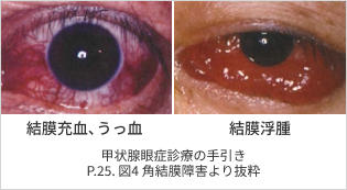 写真_結膜充血、うっ血・結膜浮腫 甲状腺眼症診療の手引きP.25. 図4 角結膜障害より抜粋
