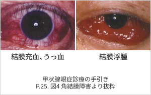 写真_結膜充血、うっ血・結膜浮腫 甲状腺眼症診療の手引きP.25. 図4 角結膜障害より抜粋