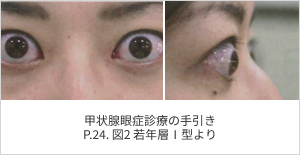 写真_眼球突出 甲状腺眼症診療の手引き P.24. 図2 若年層Ⅰ型より