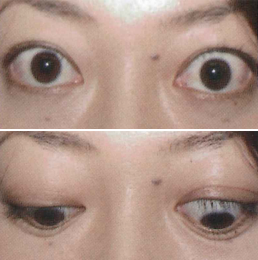 写真_上眼瞼後退 eyelid retraction