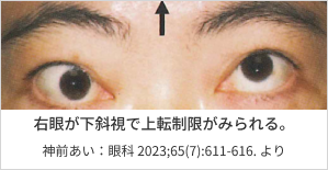 写真_右眼が下斜視で上転制限がみられる。神前あい：眼科 2023;65(7):611-616. より