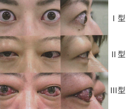 写真_眼球突出 proptosis （exophthalmos） Ⅰ型 Ⅱ型 Ⅲ型