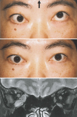 写真_斜視 strabismus
